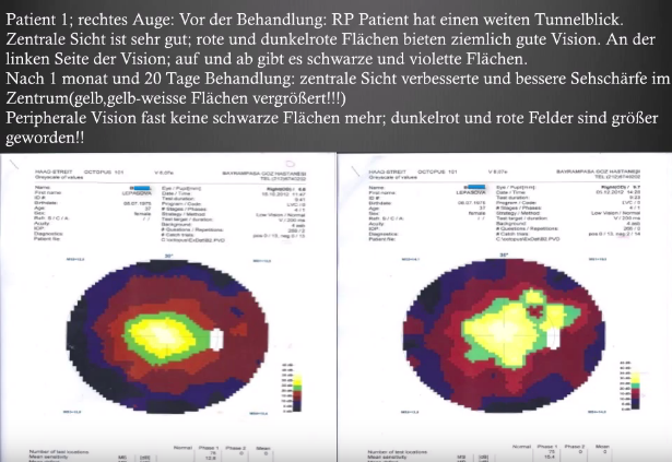Gesichtsfeldtests 3- Retinitis Pigmentosa Behandlung (Retinopathia Pigmentosa) - FIRATLI KLINIK